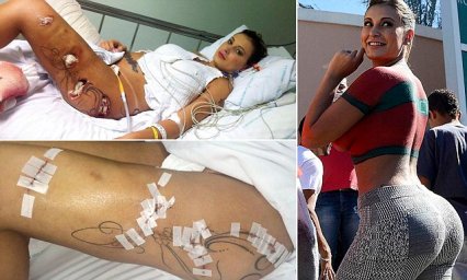 EXC - *** WARNING GRAPHIC PHOTOS *** ANDRESSA URACH, MISS BUMBUM 2012 RUNNER UP, WHO HAD RAN THE RISK OF HAVING A LEG AMPUTATED AFTER A BOTCHED COSMETIC SURGERY PROCEDURE